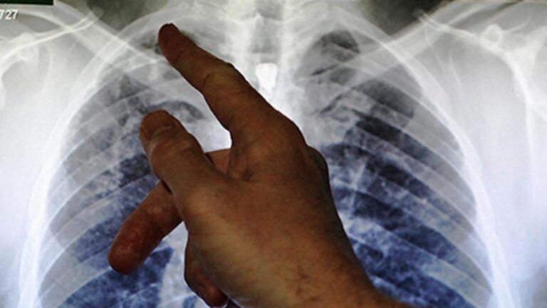 india-has-developed-indigenous-hand-held-x-ray-for-tb-screening:-icmr-director